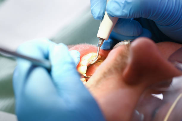 Best Emergency Dental Care for Broken or Chipped Teeth in Owings, MD